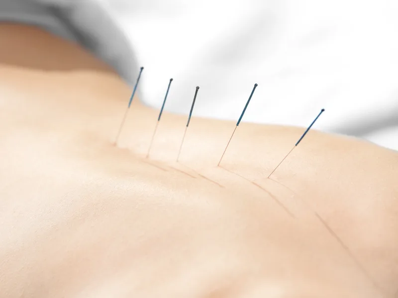 Acupuncture at Active Release TX in Heath