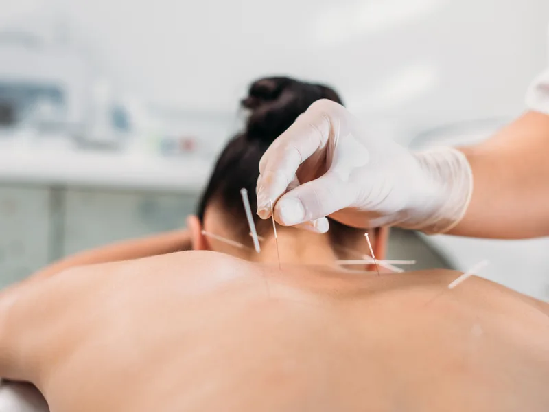 Dry Needling at Active Release TX in Heath